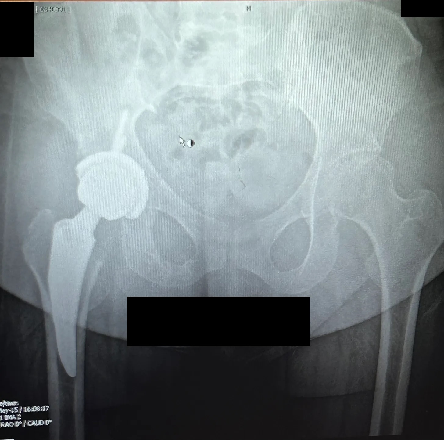 My six-month post-op X-ray. Check out that artificial hip!